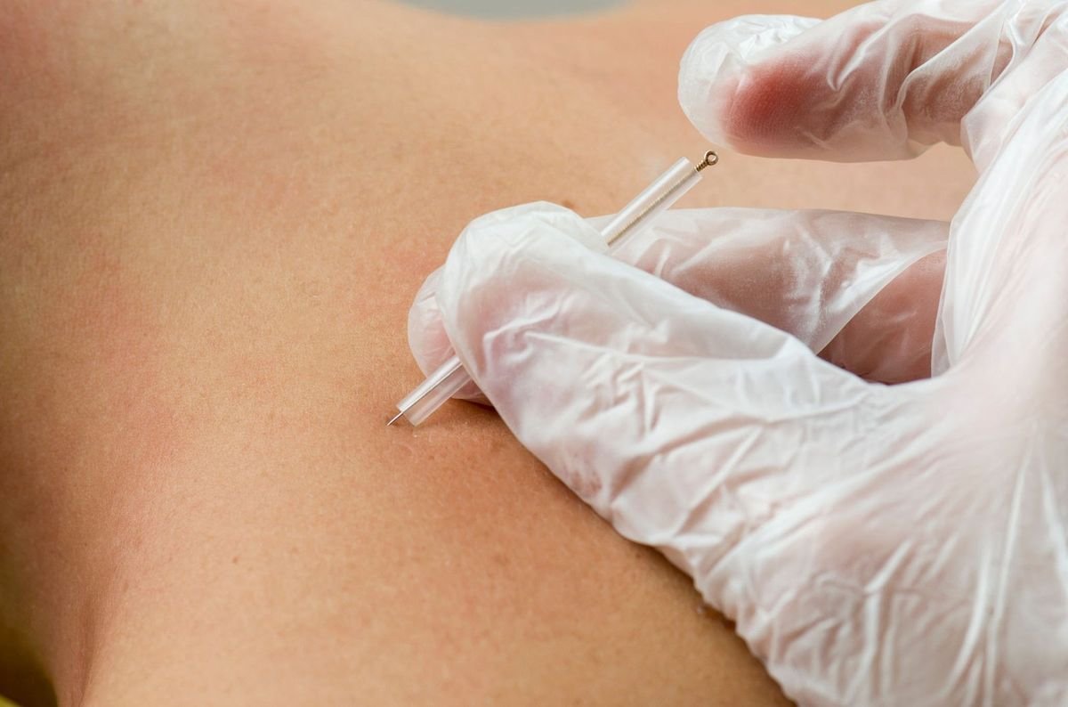 Aplicação da técnica de dry needling com agulha fina